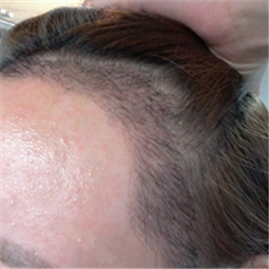 分享我頭發(fā)種植前后和恢復(fù)過(guò)程的圖片，是格萊美黃興勇做的哦~~~