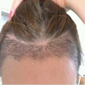 分享我頭發(fā)種植前后和恢復(fù)過(guò)程的圖片，是格萊美黃興勇做的哦~~~