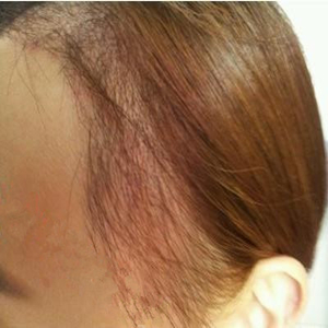 分享我頭發(fā)種植前后和恢復(fù)過(guò)程的圖片，是格萊美黃興勇做的哦~~~