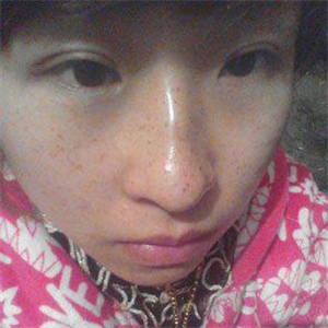 去格萊美做了激光去雀斑，有恢復(fù)前后的對(duì)比照片哦，還不錯(cuò)~~