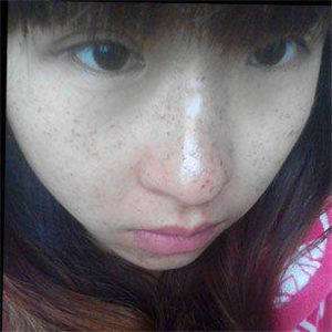 去格萊美做了激光去雀斑，有恢復(fù)前后的對(duì)比照片哦，還不錯(cuò)~~