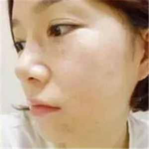 做了激光去雀斑前后對(duì)比照片分享，黃俊俊的技術(shù)很好哦！