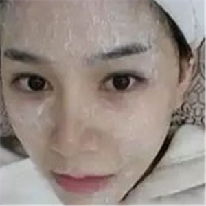 做了激光去雀斑前后對(duì)比照片分享，黃俊俊的技術(shù)很好哦！