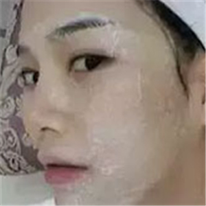 做了激光去雀斑前后對(duì)比照片分享，黃俊俊的技術(shù)很好哦！