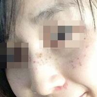 花費(fèi)4000元做了激光祛斑，終于把雀斑消滅了555555