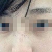 花費(fèi)4000元做了激光祛斑，終于把雀斑消滅了555555