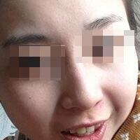 花費(fèi)4000元做了激光祛斑，終于把雀斑消滅了555555