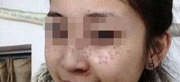 花費(fèi)4000元做了激光祛斑，終于把雀斑消滅了