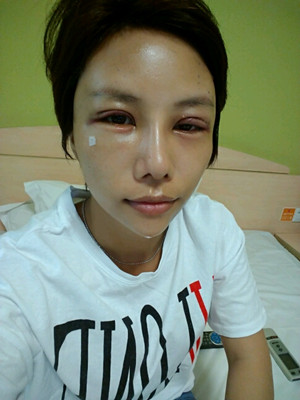 美萊鄧正輝做的切開雙眼皮 終于變美了