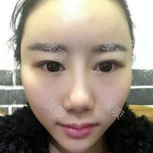 給大家分享下我的自體脂肪面部填充過(guò)程希望對(duì)大家有幫助