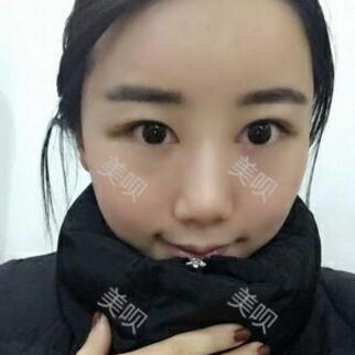 給大家分享下我的自體脂肪面部填充過(guò)程希望對(duì)大家有幫助