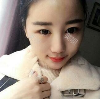 給大家分享下我的自體脂肪面部填充過(guò)程希望對(duì)大家有幫助