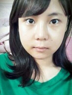 柳大烈給我做的磨下頜角 看看我的果如何~