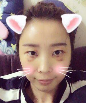 自體脂肪面部填充告別干癟消瘦的臉