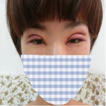 雙眼皮修復(fù)成功辣  再也不用擔(dān)心異樣的眼光辣