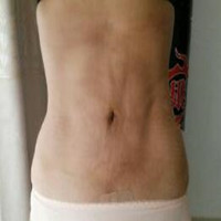 抽脂減肥瘦小腹 終于可以不用節(jié)食鍛煉了