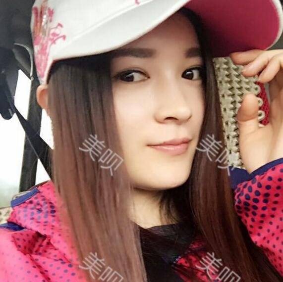 我做了玻尿酸隆鼻后被同學(xué)叫網(wǎng)紅哈哈~~~