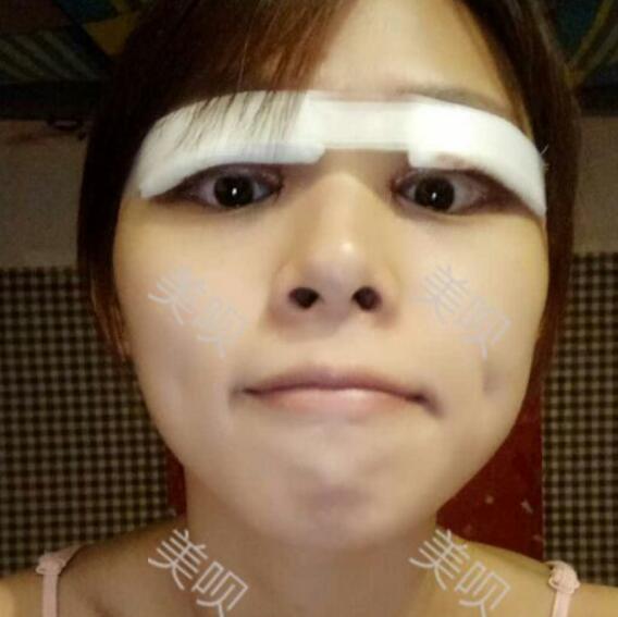 在東莞華美做的切開(kāi)雙眼皮感覺(jué)果棒棒噠