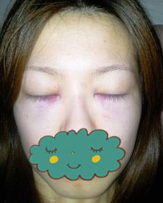 杭州時(shí)光激光去眼袋1個(gè)月了