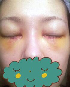 杭州時(shí)光激光去眼袋1個(gè)月了