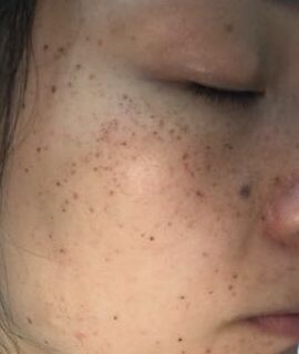 激光去黃褐斑后皮膚干凈多了呢