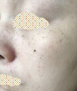 激光去黃褐斑后皮膚干凈多了呢