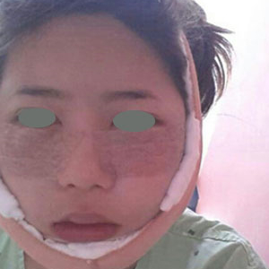 下頜角整形手術(shù)三個(gè)多月了，分享下我的恢復(fù)前后對(duì)比果圖片吧~