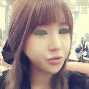 下頜角整形手術(shù)三個(gè)多月了，分享下我的恢復(fù)前后對(duì)比果圖片吧~