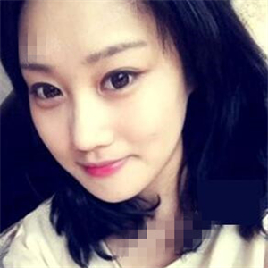 看看我磨下頜角整形手術(shù)恢復(fù)前后的對(duì)比圖片，同學(xué)都說我像張馨予~~