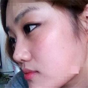 看看我磨下頜角整形手術(shù)恢復(fù)前后的對(duì)比圖片，同學(xué)都說我像張馨予~~