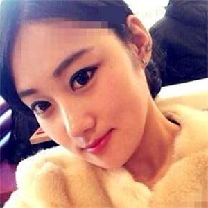 看看我磨下頜角整形手術(shù)恢復(fù)前后的對(duì)比圖片，同學(xué)都說我像張馨予~~