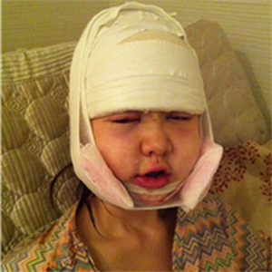 上海華美李志海做的v－line瓜子臉手術(shù)，果太好了~哈哈哈~