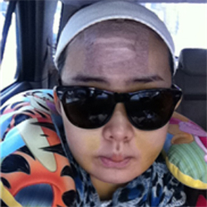 上海華美李志海做的v－line瓜子臉手術(shù)，果太好了~哈哈哈~