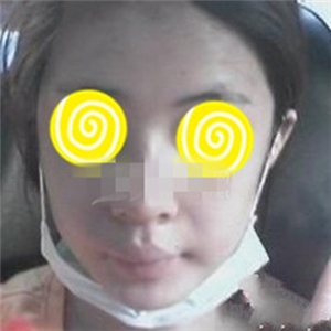 自體耳軟骨隆鼻手術(shù)恢復(fù)過(guò)程和前后對(duì)比圖分享，變化太大啦~~~