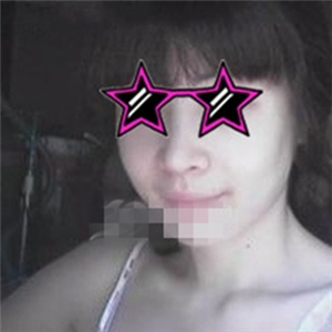 自體耳軟骨隆鼻手術(shù)恢復(fù)過(guò)程和前后對(duì)比圖分享，變化太大啦~~~