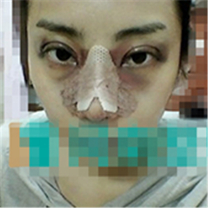 首爾麗格洪性范耳軟骨隆鼻案例