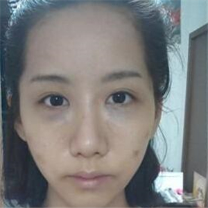 顴骨提高手術(shù)恢復(fù)前后的對比圖片分享，果很好的說~