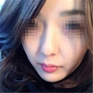 打B****告別大餅?zāi)槪謴?fù)前后的對比果照片給你們看看哦