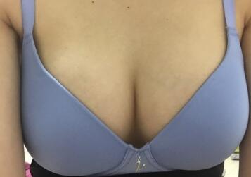 點(diǎn)擊圖片查看胸下切口假體隆胸恢復(fù)分享