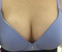 曼托假體豐胸價格恢復(fù)果圖