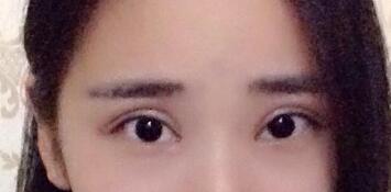 切開雙眼皮價格2680元，割雙眼皮拆線后圖片