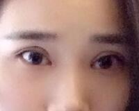 切開雙眼皮價(jià)格2680元，費(fèi)用不貴果卻很好