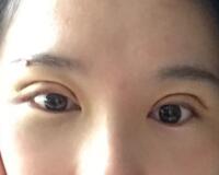 割雙眼皮過(guò)程恢復(fù)圖分享給大家，單眼皮變雙眼皮