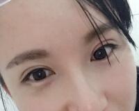 割雙眼皮過(guò)程恢復(fù)圖分享給大家，單眼皮變雙眼皮