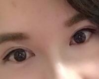 割雙眼皮過(guò)程恢復(fù)圖分享給大家，單眼皮變雙眼皮