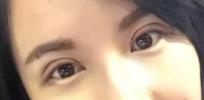 切開雙眼皮拆線