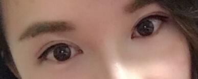 割雙眼皮過(guò)程恢復(fù)圖分享給大家，單眼皮變雙眼皮