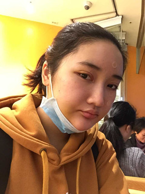 自體脂肪填充額頭以后變化很大