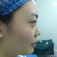 硅膠假體隆鼻后恢復(fù)得很漂亮下一步的目標是自體脂肪全臉填充