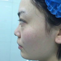 硅膠假體隆鼻后恢復(fù)得很漂亮下一步的目標是自體脂肪全臉填充